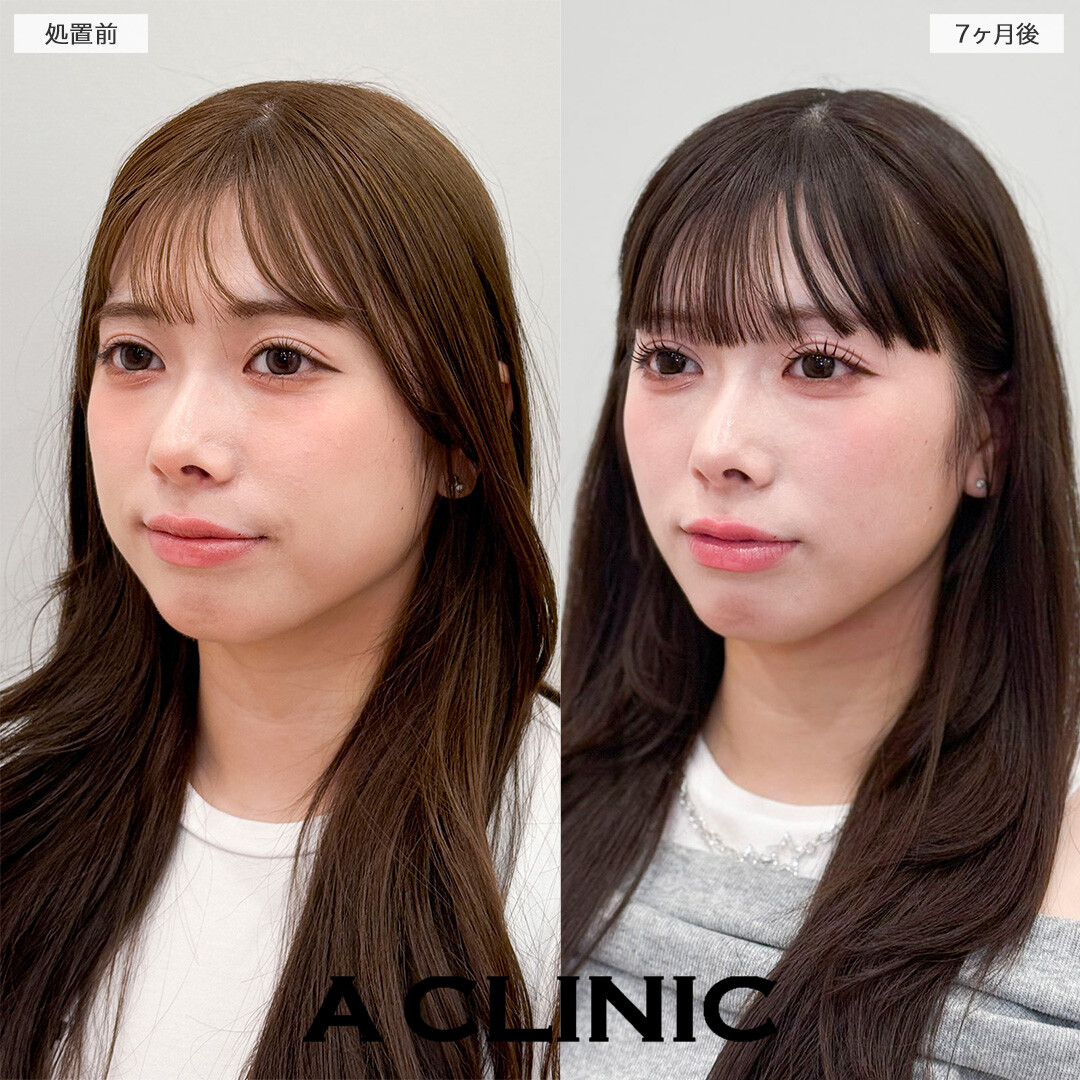 1day小顔脂肪吸引とバッカルファット除去術で半年経っても綺麗な輪郭をキープ！処置前と7ヶ月後の症例です(20代女性)