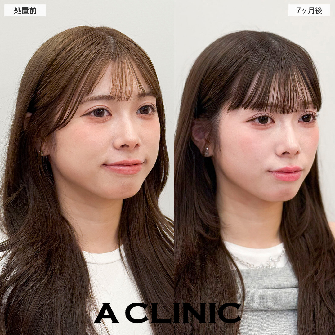 1day小顔脂肪吸引とバッカルファット除去術で半年経っても綺麗な輪郭をキープ！処置前と7ヶ月後の症例です(20代女性)