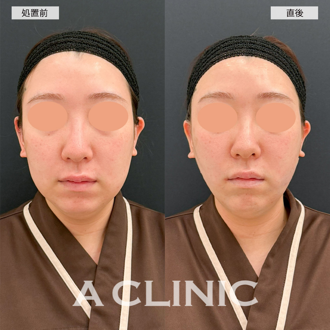 1day小顔脂肪吸引で直後から口横のポニョっと感が無くなりました！こちら処置前と直後の症例です(20代女性)