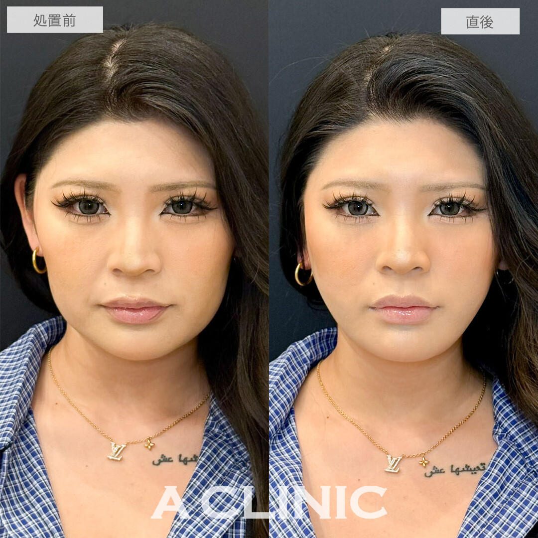 1day小顔なら直後から輪郭が整ったことが実感できます！こちら処置前と直後の症例です(20代女性)