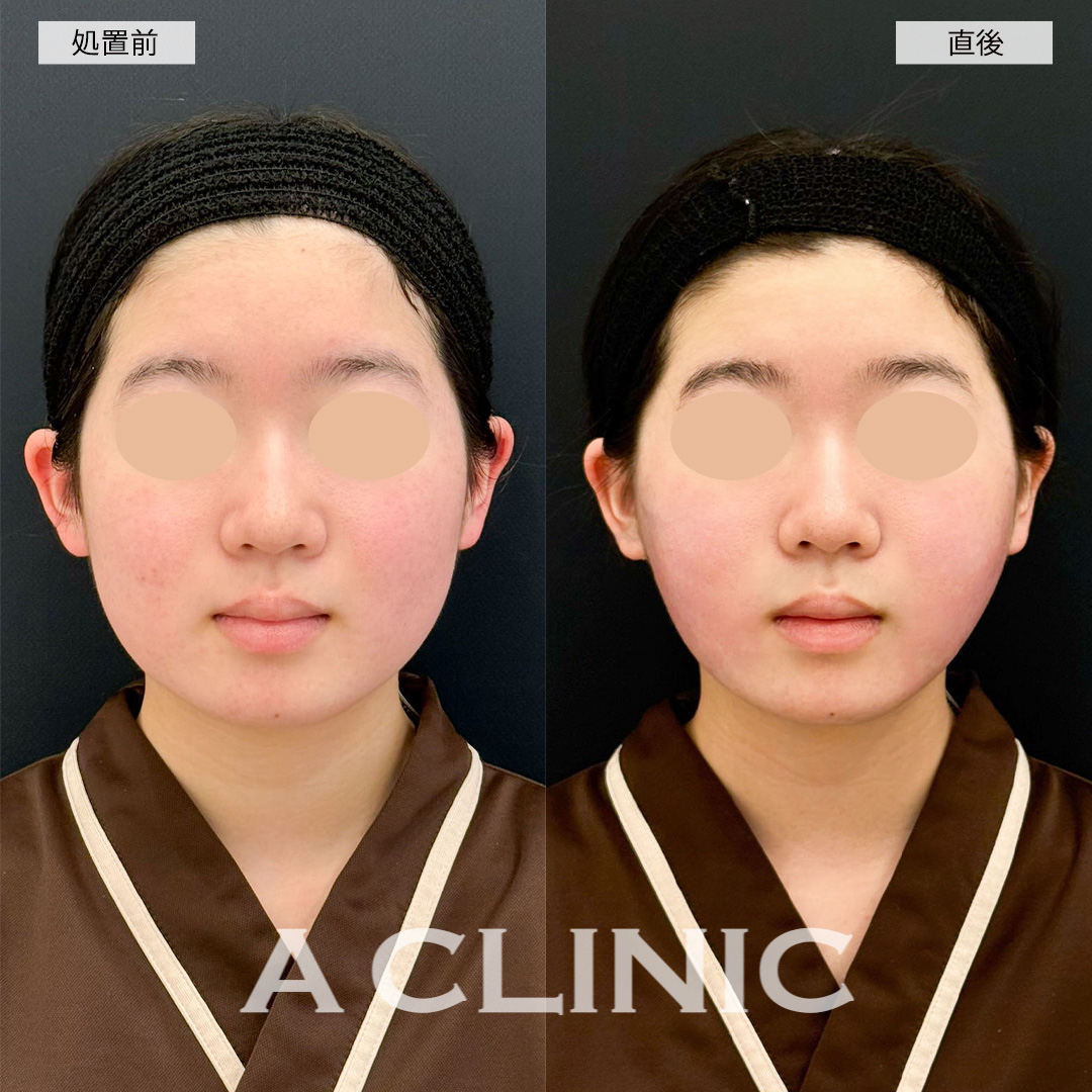 1day小顔脂肪吸引で直後から理想のフェイスラインが爆誕！こちら処置前と直後の症例です(10代女性)