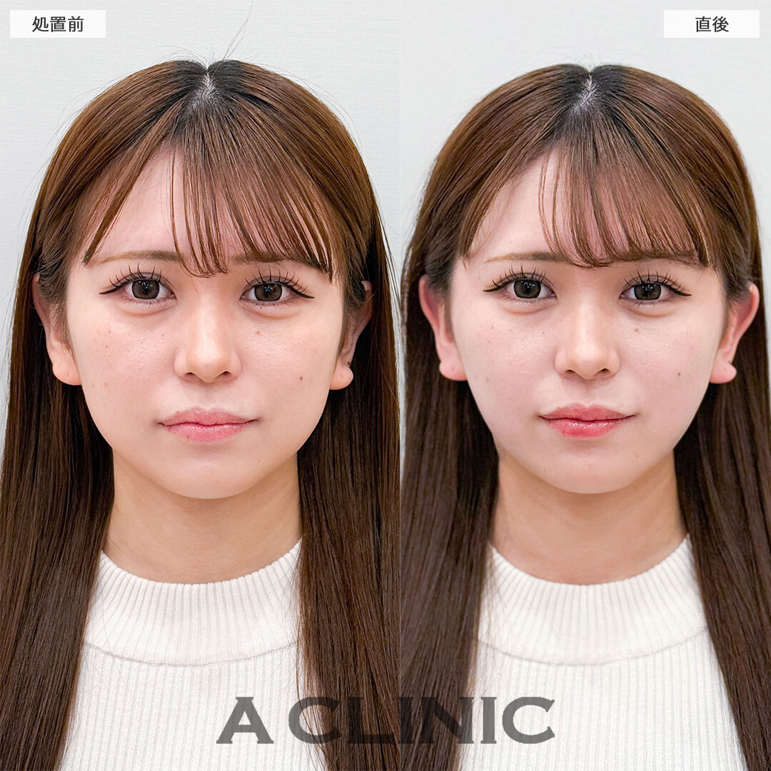 1day小顔脂肪吸引なら直後から腫れ最小限で効果を実感！こちら処置前と直後の症例です(20代女性)