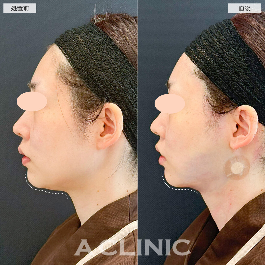 1day小顔脂肪吸引でお悩みだった二重顎に直後から変化が出ました！処置前と直後の症例です(30代女性)