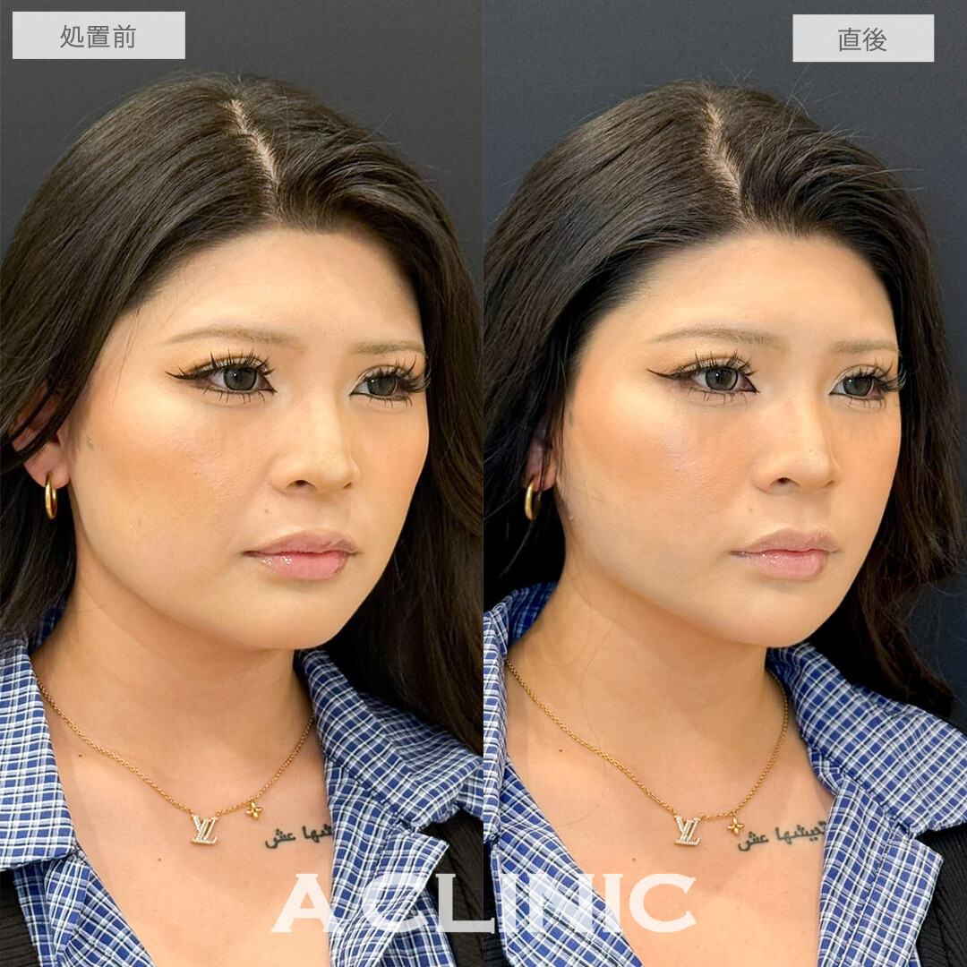 1day小顔なら直後から輪郭が整ったことが実感できます！こちら処置前と直後の症例です(20代女性)