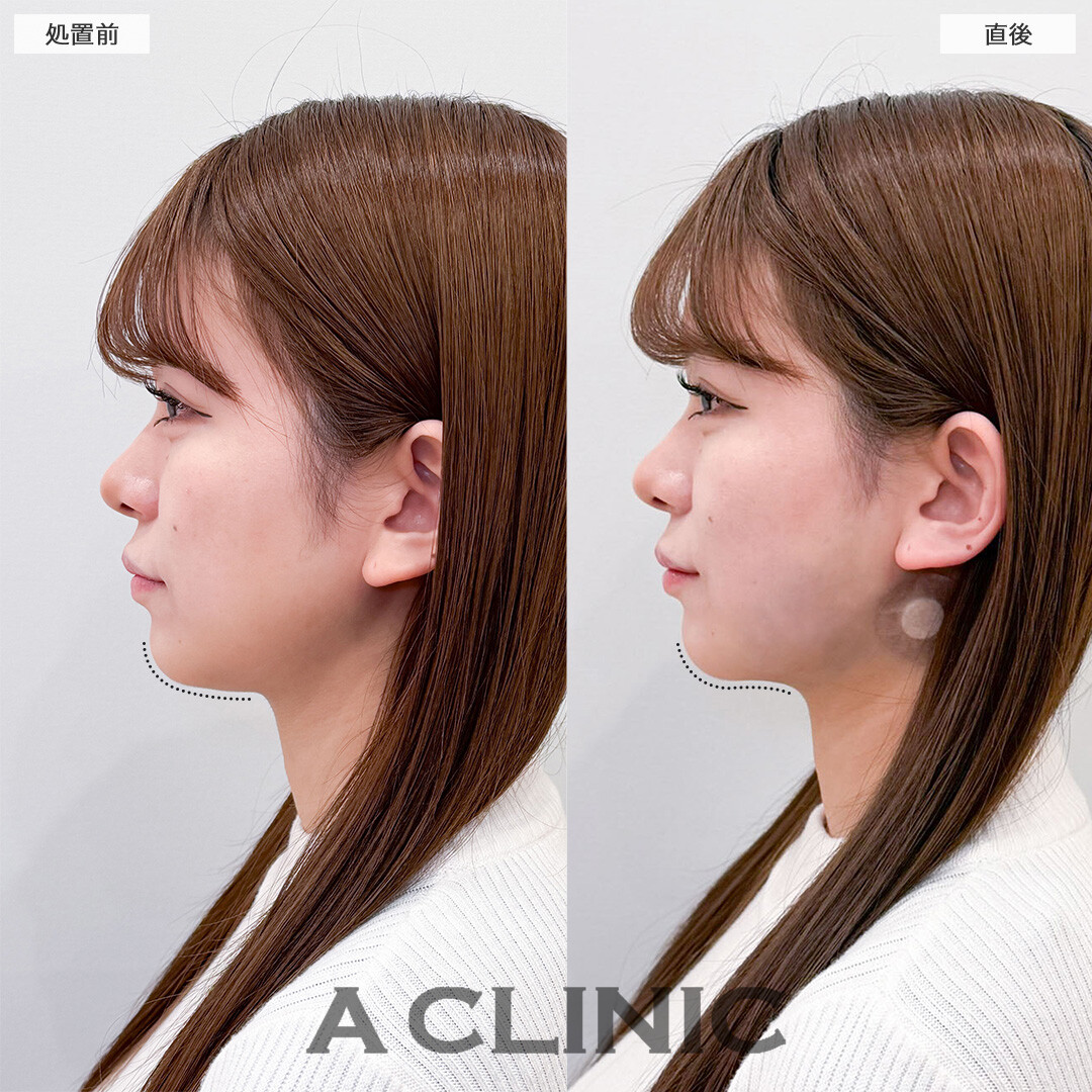 1day小顔脂肪吸引なら直後から腫れ最小限で効果を実感！こちら処置前と直後の症例です(20代女性)