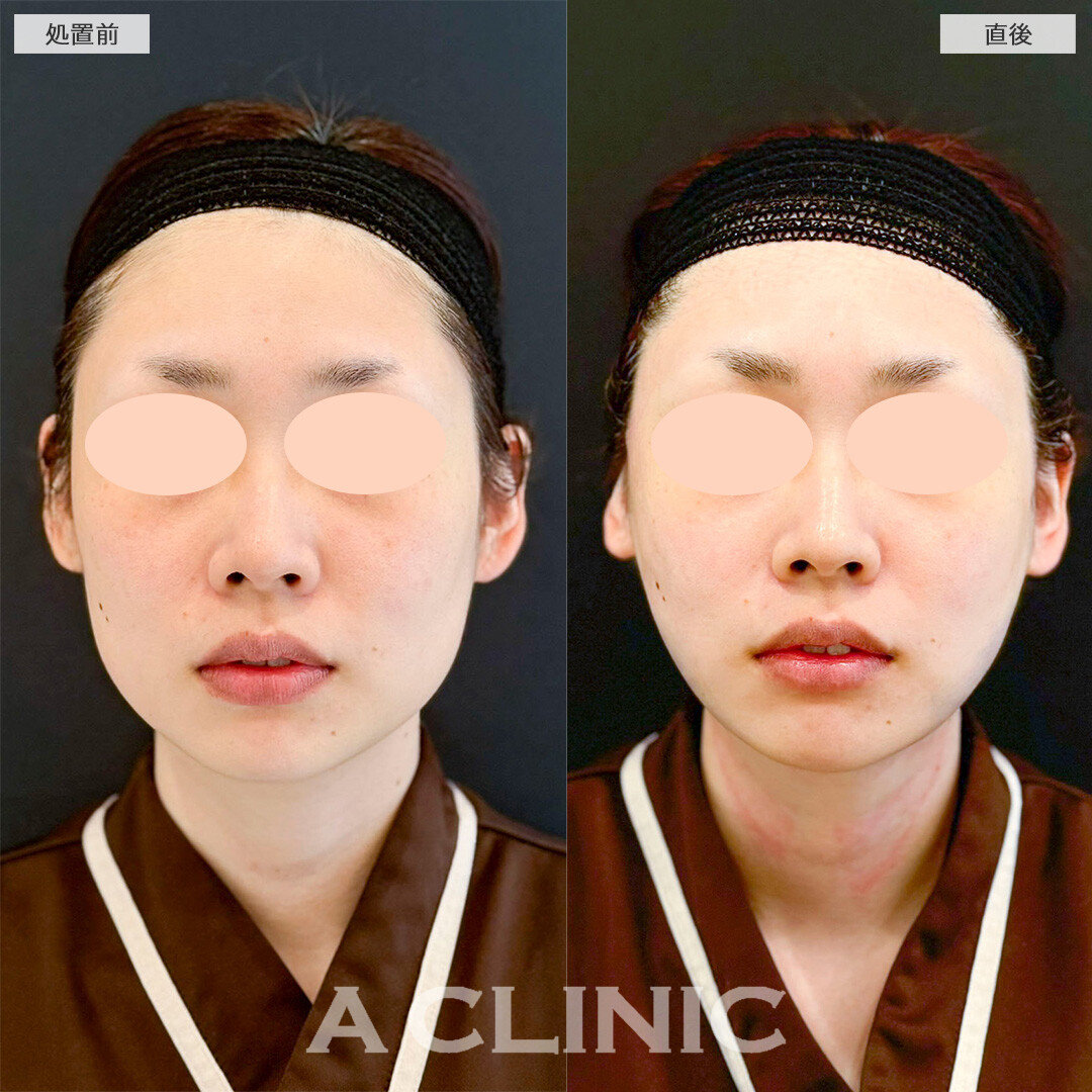 1day小顔脂肪吸引でお悩みだった二重顎に直後から変化が出ました！処置前と直後の症例です(30代女性)