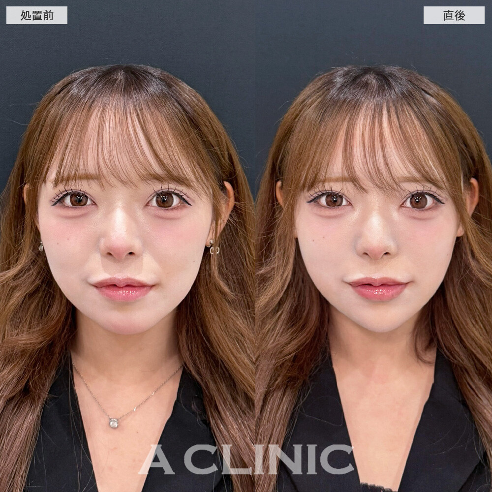 1day小顔脂肪吸引なら直後から腫れるどころか即効小顔になって念願のVフェイスに！こちら処置前と直後の症例です(10代女性)