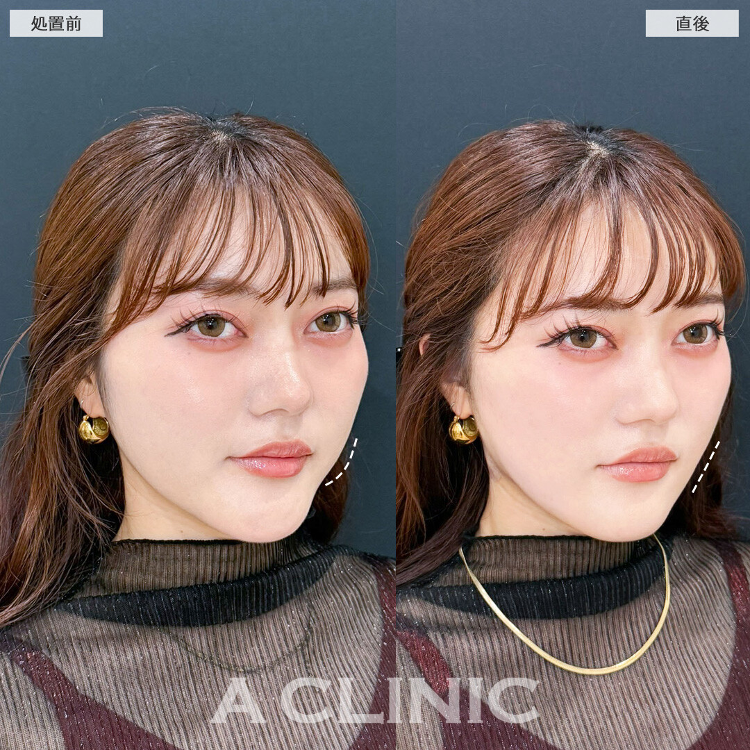 1day小顔脂肪吸引で直後でも腫れが少なくアゴ下のお肉やフェイスラインを引き締められました！処置前と直後の症例です(20代女性)