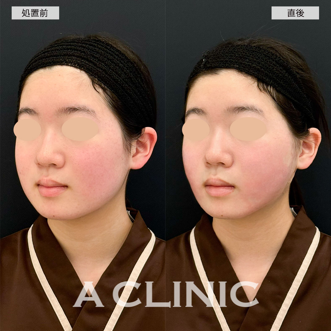 1day小顔脂肪吸引で直後から理想のフェイスラインが爆誕！こちら処置前と直後の症例です(10代女性)
