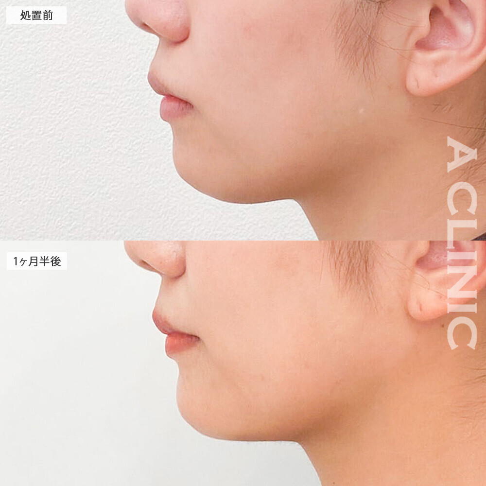 1day小顔脂肪吸引とあごへのヒアルロン酸注入で横顔美人になりました！こちら処置前から2ヶ月半後の症例です(30代女性)