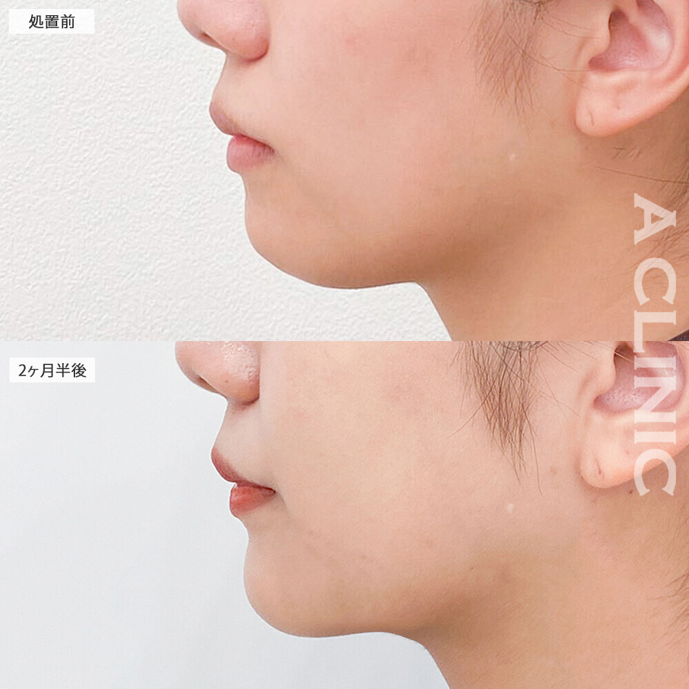 1day小顔脂肪吸引とあごへのヒアルロン酸注入で横顔美人になりました！こちら処置前から2ヶ月半後の症例です(30代女性)