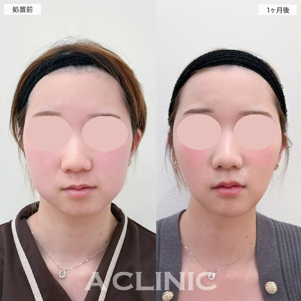 1day小顔脂肪吸引とバッカルファット除去術でお顔が一回り小さくなりました！こちら処置前から6ヶ月後の症例です(20代女性)