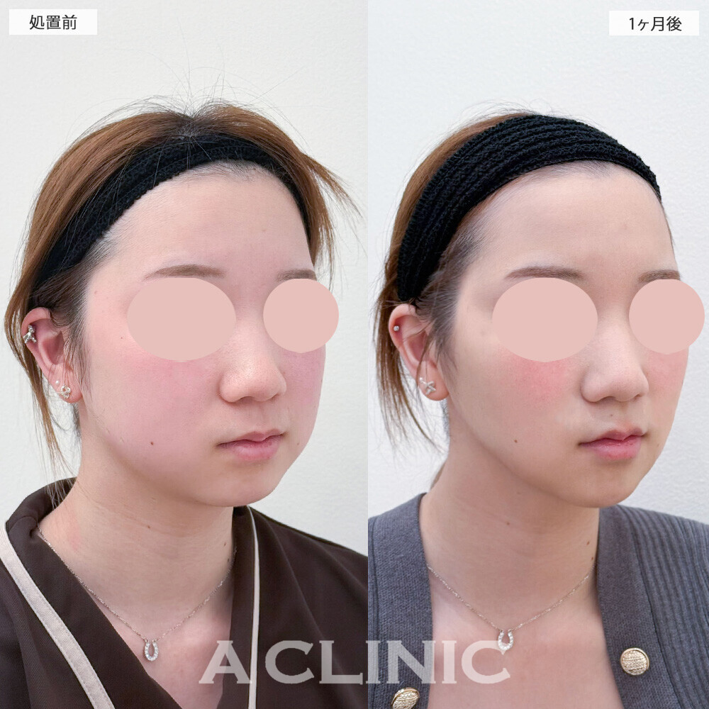1day小顔脂肪吸引とバッカルファット除去術でお顔が一回り小さくなりました！こちら処置前から6ヶ月後の症例です(20代女性)