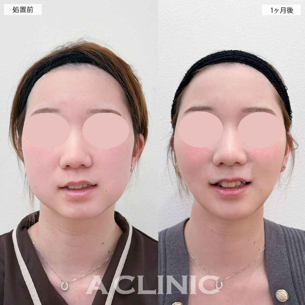 1day小顔脂肪吸引とバッカルファット除去術でお顔が一回り小さくなりました！こちら処置前から6ヶ月後の症例です(20代女性)