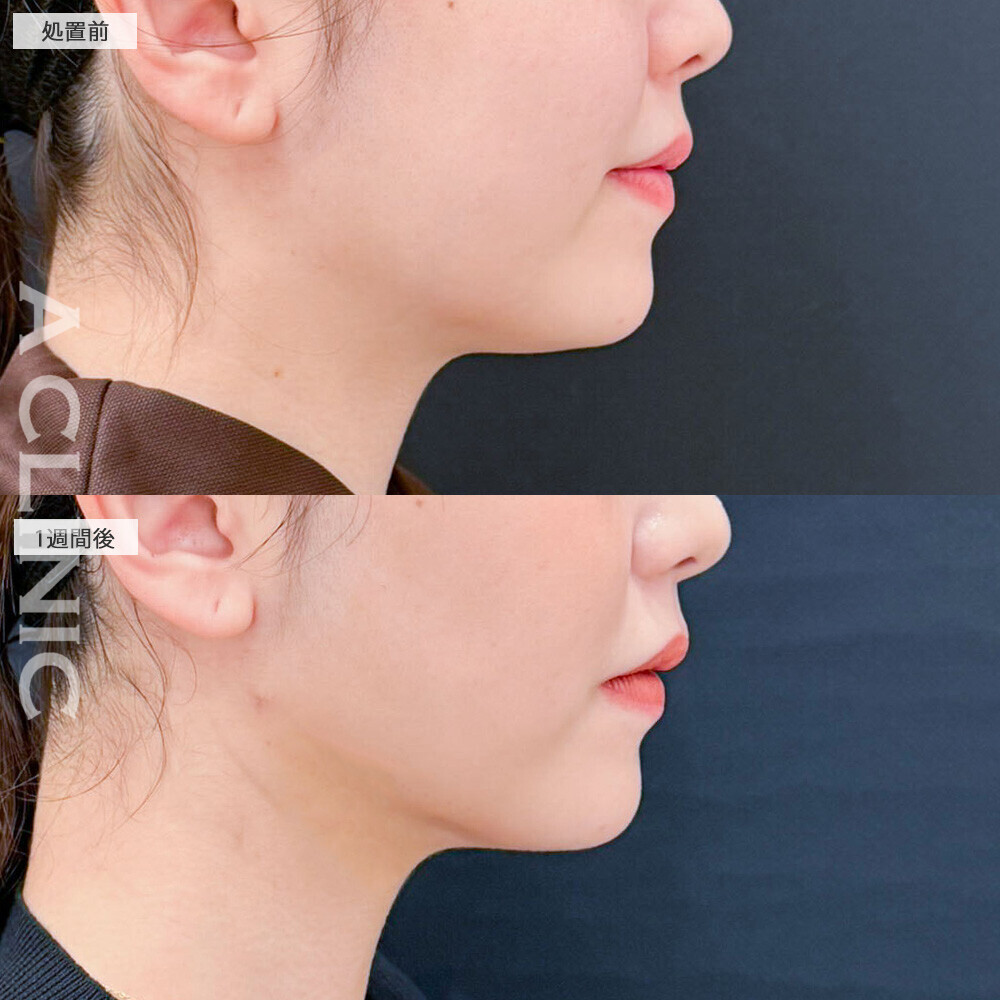 1day小顔脂肪吸引とバッカルファット除去術で頬のぷくっと感が改善！こちら処置前と1週間後の症例です(20代女性)