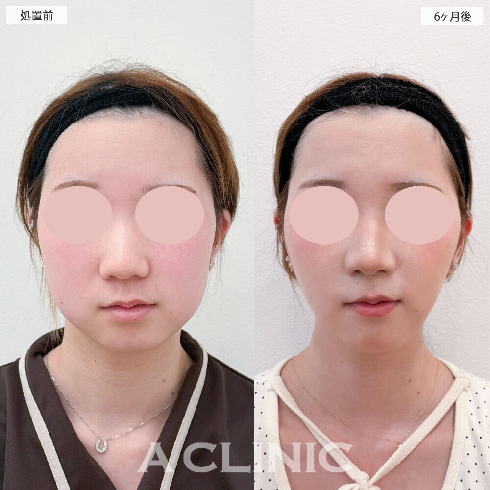 1day小顔脂肪吸引とバッカルファット除去術でお顔が一回り小さくなりました！こちら処置前から6ヶ月後の症例です(20代女性)