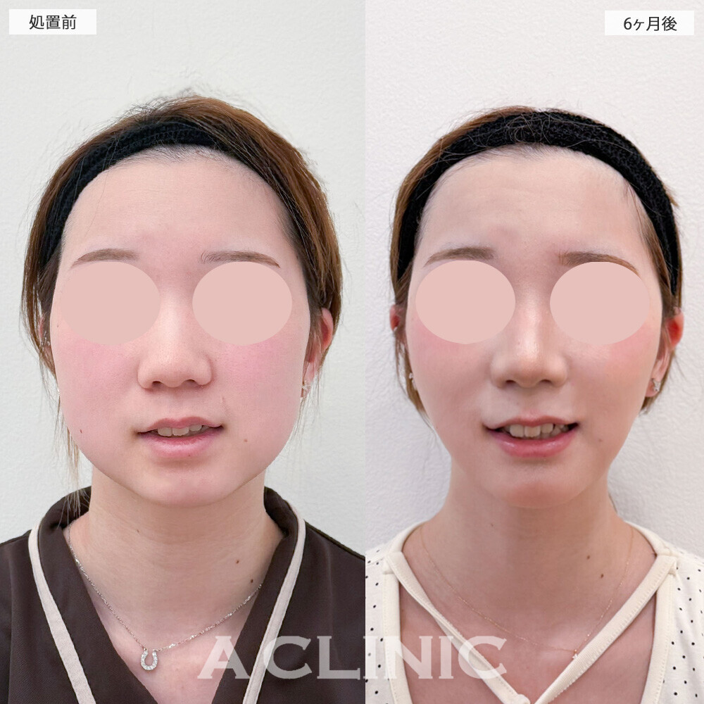 1day小顔脂肪吸引とバッカルファット除去術でお顔が一回り小さくなりました！こちら処置前から6ヶ月後の症例です(20代女性)