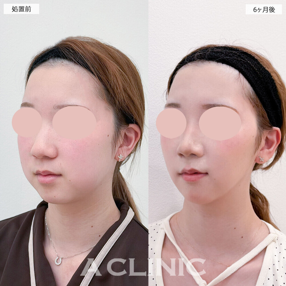 1day小顔脂肪吸引とバッカルファット除去術でお顔が一回り小さくなりました！こちら処置前から6ヶ月後の症例です(20代女性)