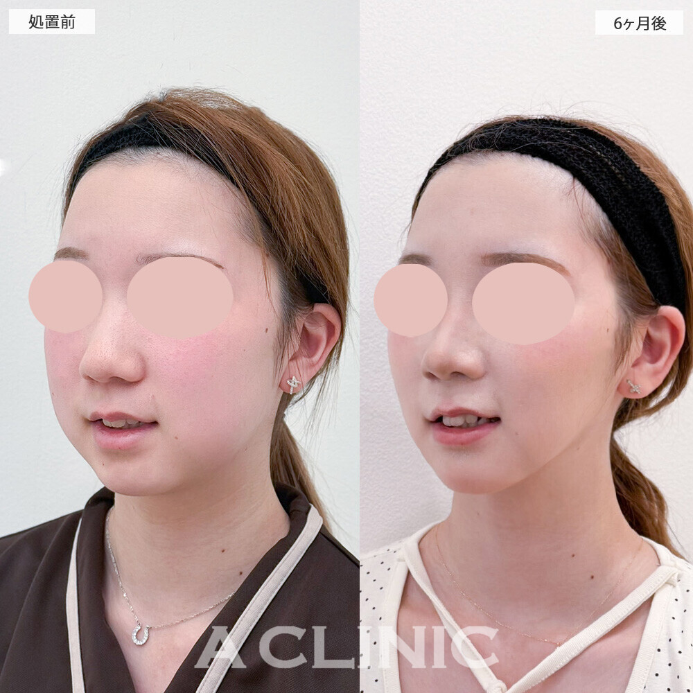 1day小顔脂肪吸引とバッカルファット除去術でお顔が一回り小さくなりました！こちら処置前から6ヶ月後の症例です(20代女性)