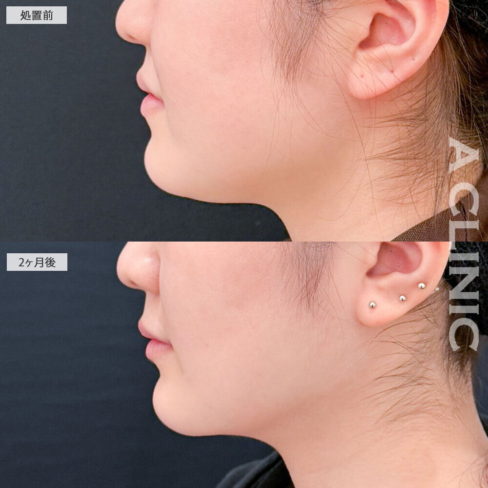 脂肪吸引でひと回りスッキリした小顔に！1day小顔脂肪吸引とナゾラビアルファット除去術とバッカルファット除去術の処置前と2ヶ月後の症例です(20代女性)