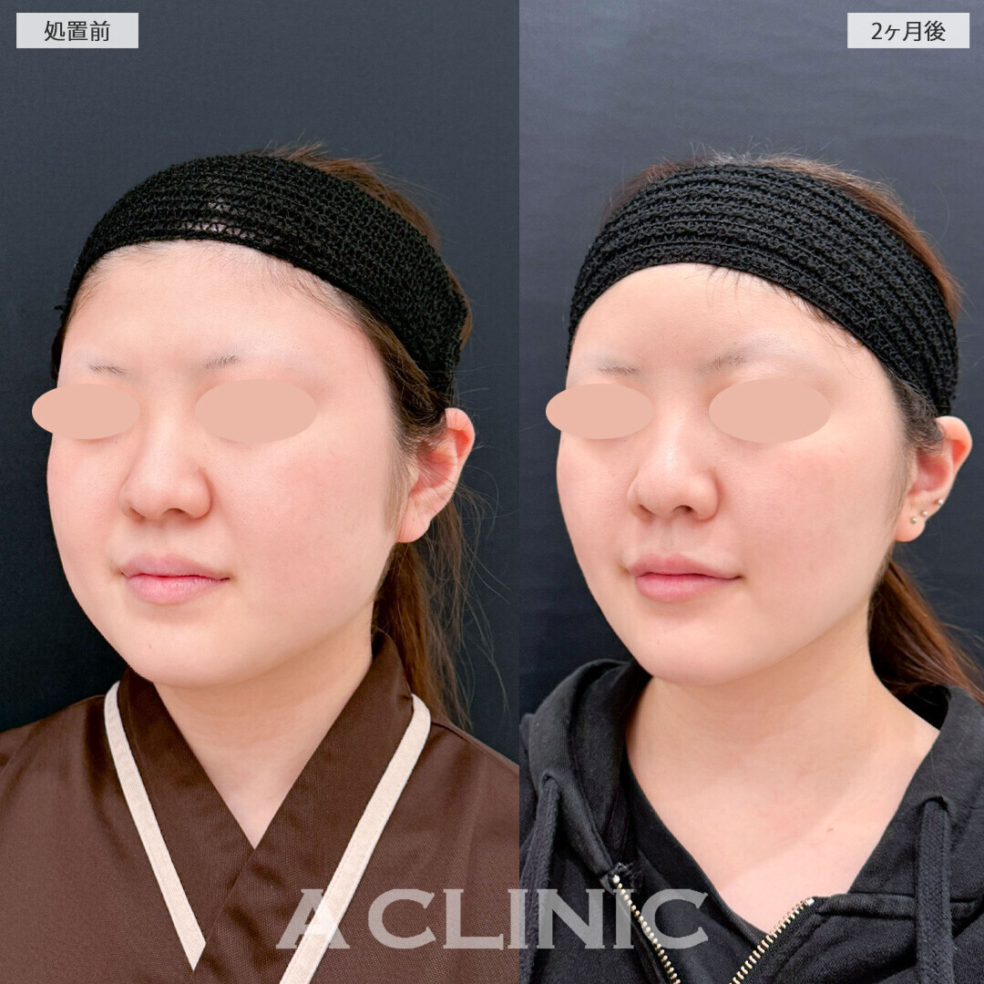 脂肪吸引でひと回りスッキリした小顔に！1day小顔脂肪吸引とナゾラビアルファット除去術とバッカルファット除去術の処置前と2ヶ月後の症例です(20代女性)