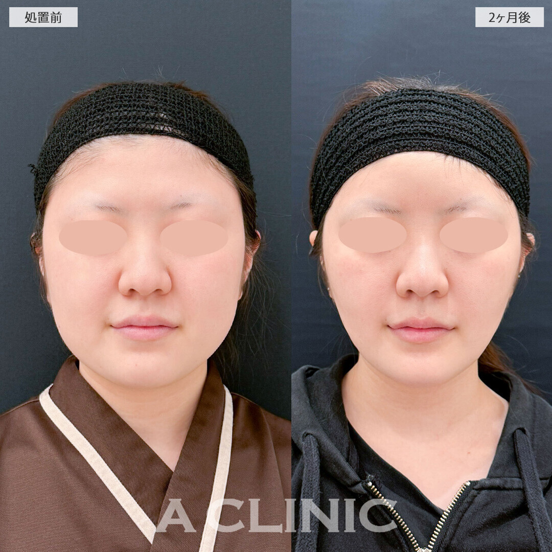 脂肪吸引でひと回りスッキリした小顔に！1day小顔脂肪吸引とナゾラビアルファット除去術とバッカルファット除去術の処置前と2ヶ月後の症例です(20代女性)