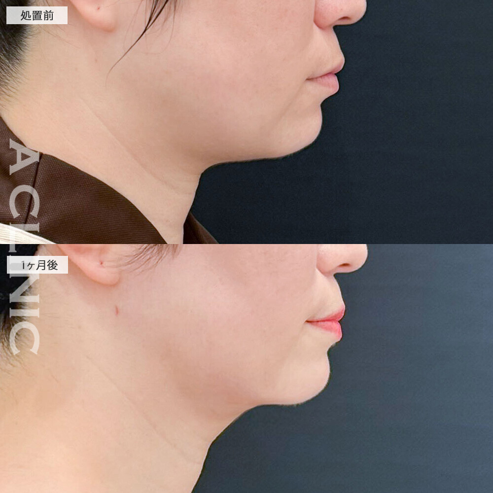 1day小顔脂肪吸引と小顔エラボトックスで頬のぷっくり感解消！こちら処置前から2ヶ月後の症例です(30代女性)