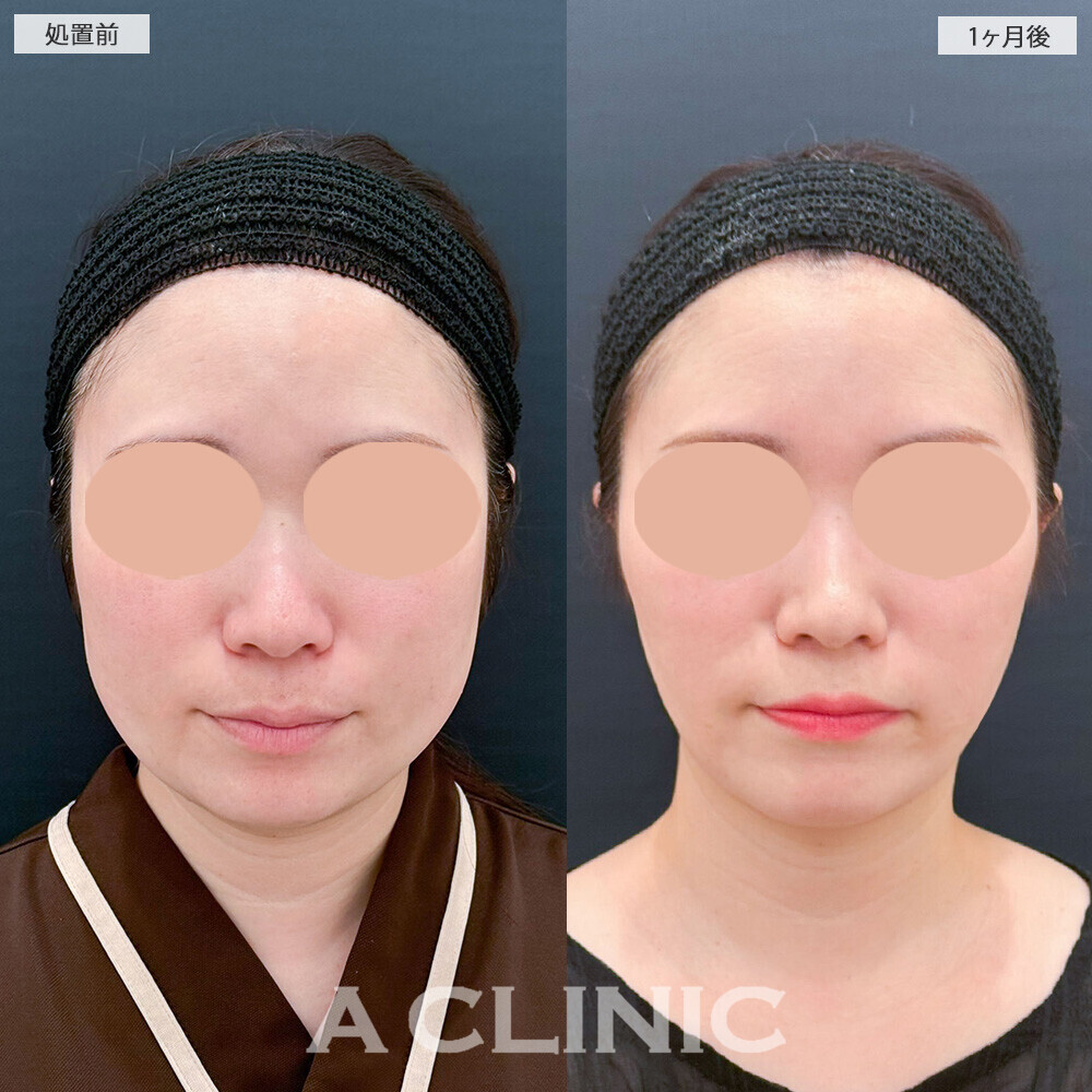 1day小顔脂肪吸引と小顔エラボトックスで頬のぷっくり感解消！こちら処置前から2ヶ月後の症例です(30代女性)