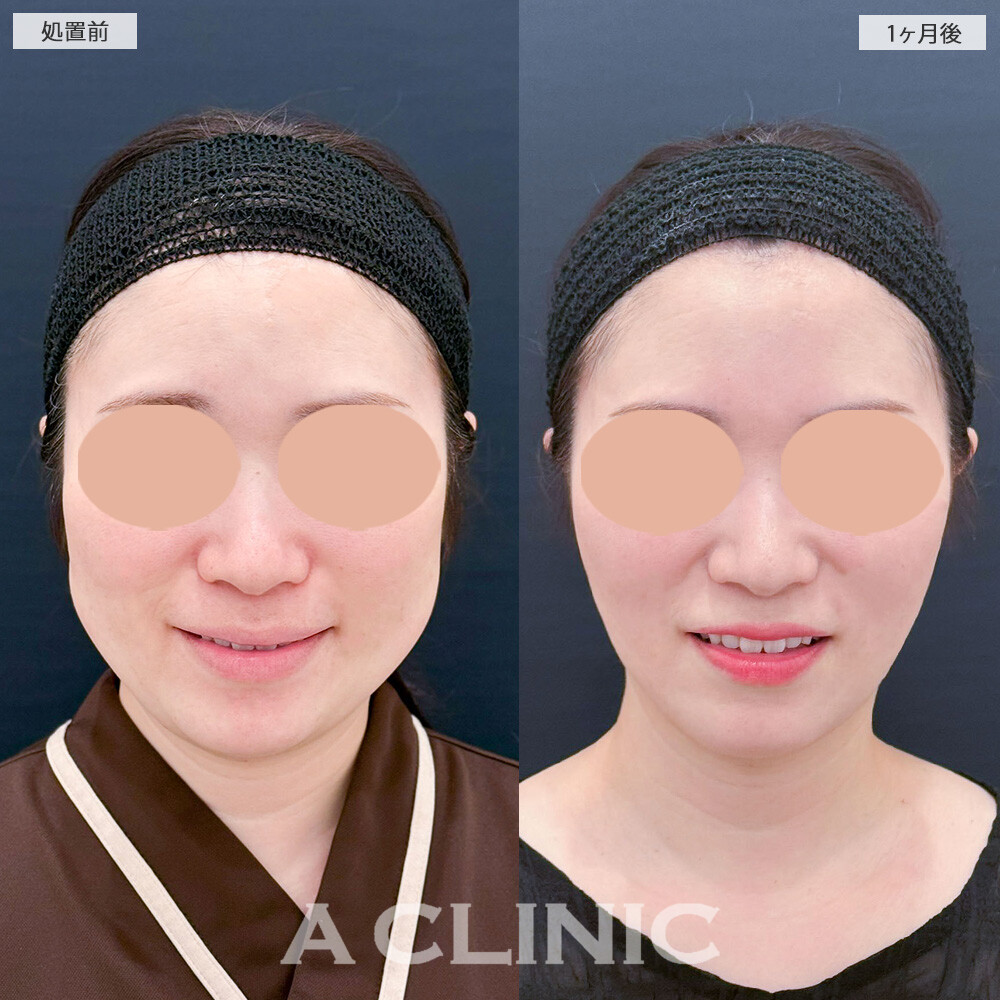 1day小顔脂肪吸引と小顔エラボトックスで頬のぷっくり感解消！こちら処置前から2ヶ月後の症例です(30代女性)