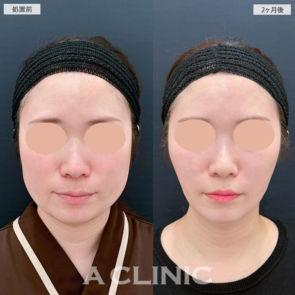 1day小顔脂肪吸引と小顔エラボトックスで頬のぷっくり感解消！こちら処置前から2ヶ月後の症例です(30代女性)