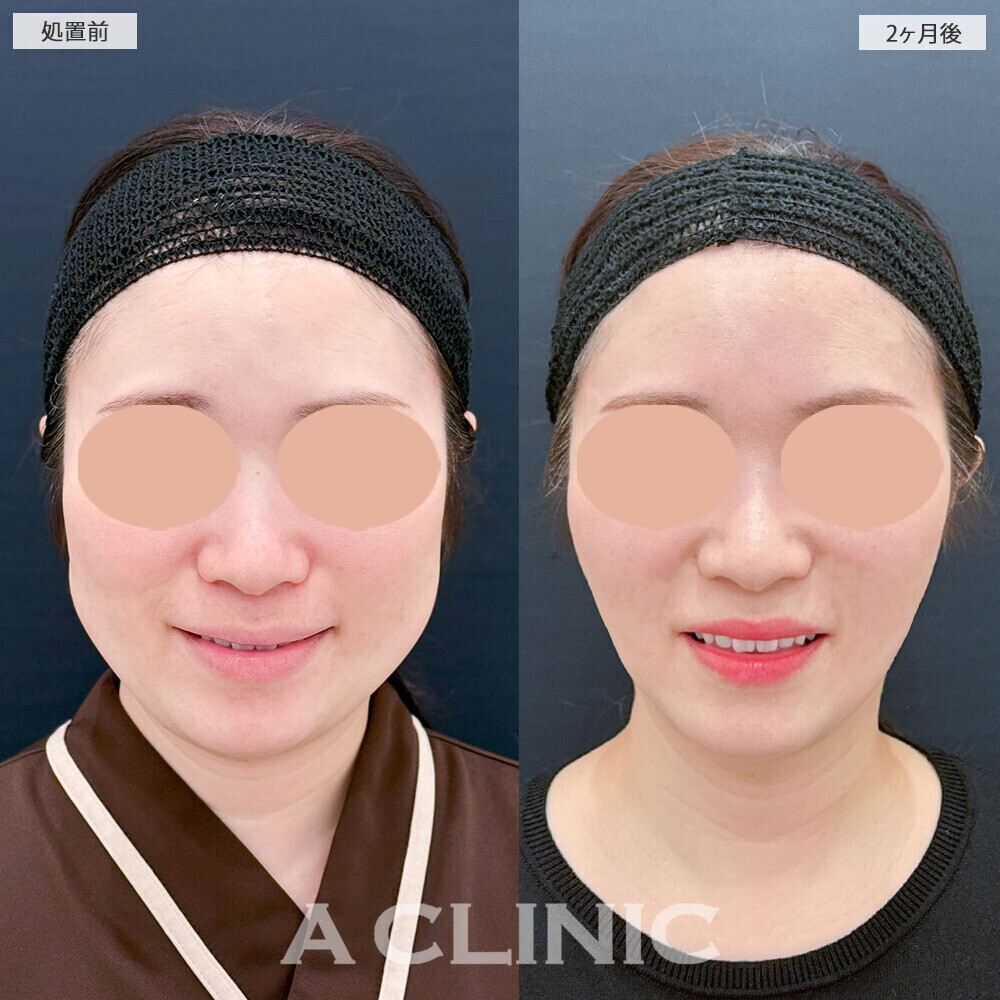 1day小顔脂肪吸引と小顔エラボトックスで頬のぷっくり感解消！こちら処置前から2ヶ月後の症例です(30代女性)