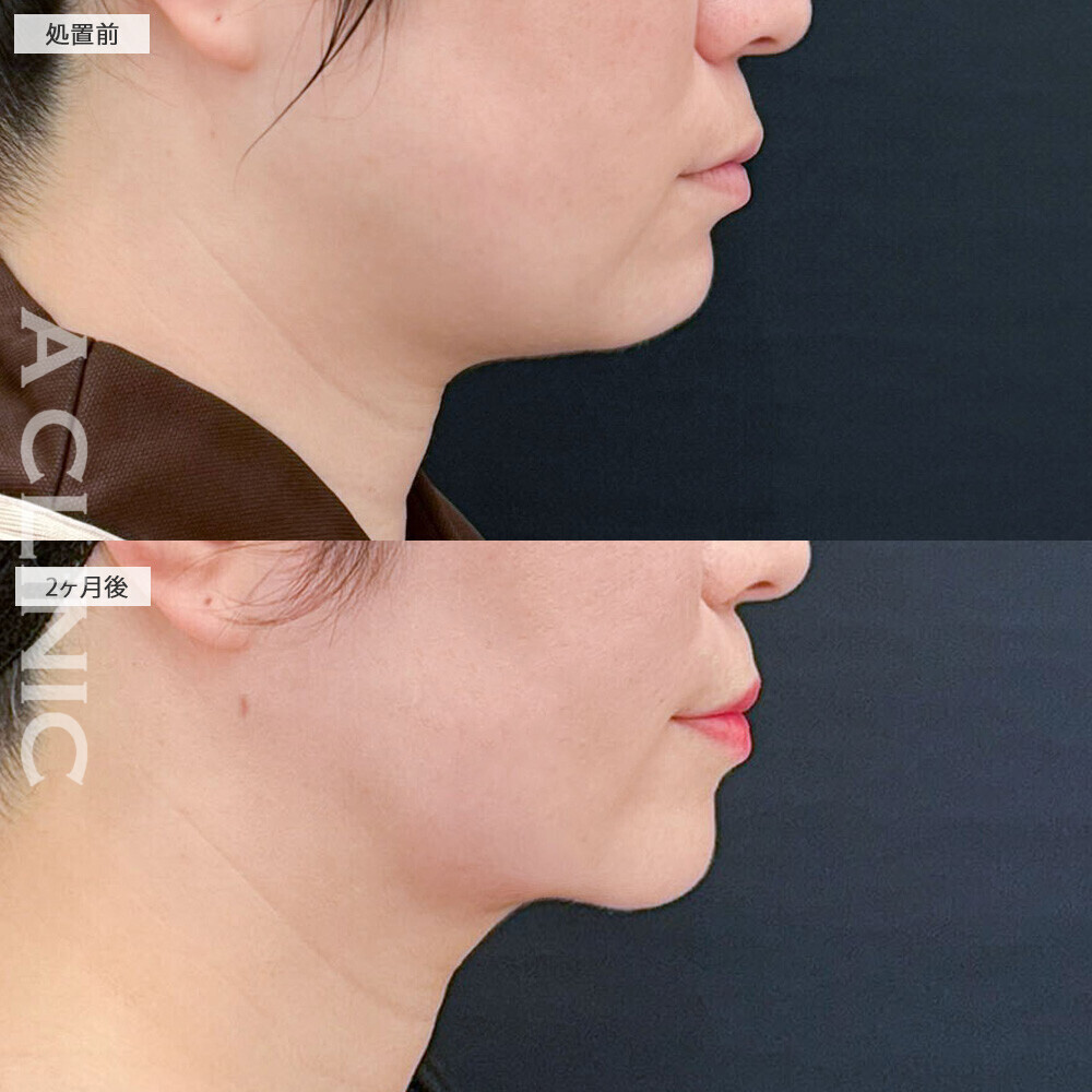 1day小顔脂肪吸引と小顔エラボトックスで頬のぷっくり感解消！こちら処置前から2ヶ月後の症例です(30代女性)