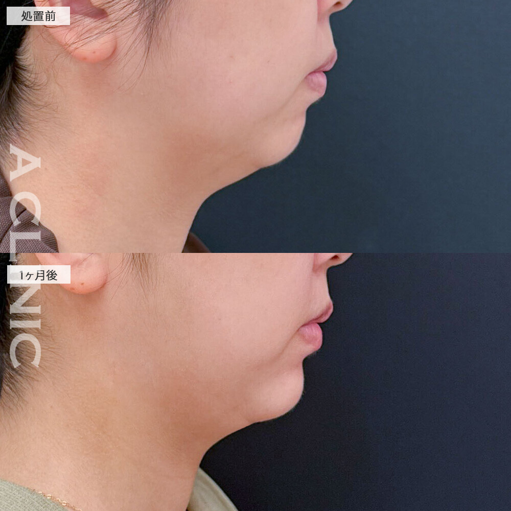 1day小顔脂肪吸引と小顔エラボトックスで二重あごが気にならなくなりました！こちら処置前から2ヶ月後の症例です(30代女性)