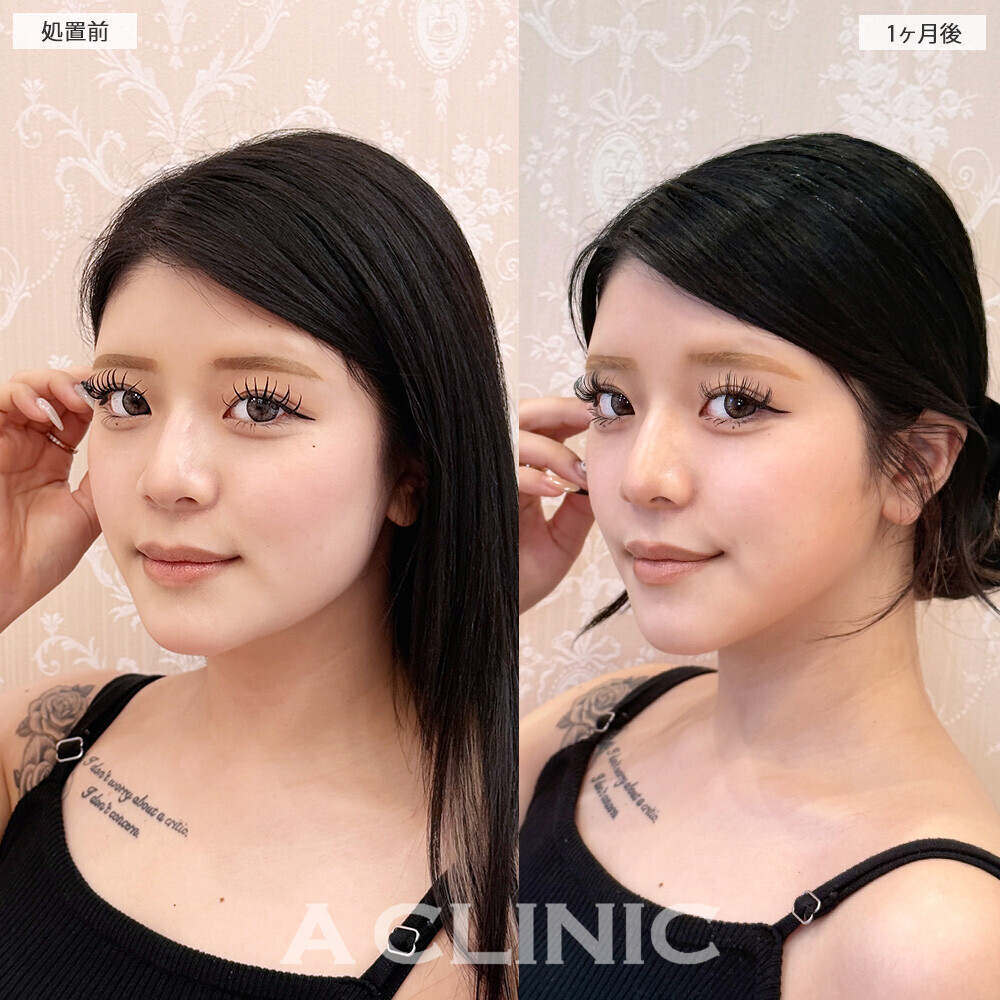 1day小顔脂肪吸引と小顔エラボトックスで輪郭が変わるだけで垢抜け成功！こちら処置前から2ヶ月後の症例です(10代女性)