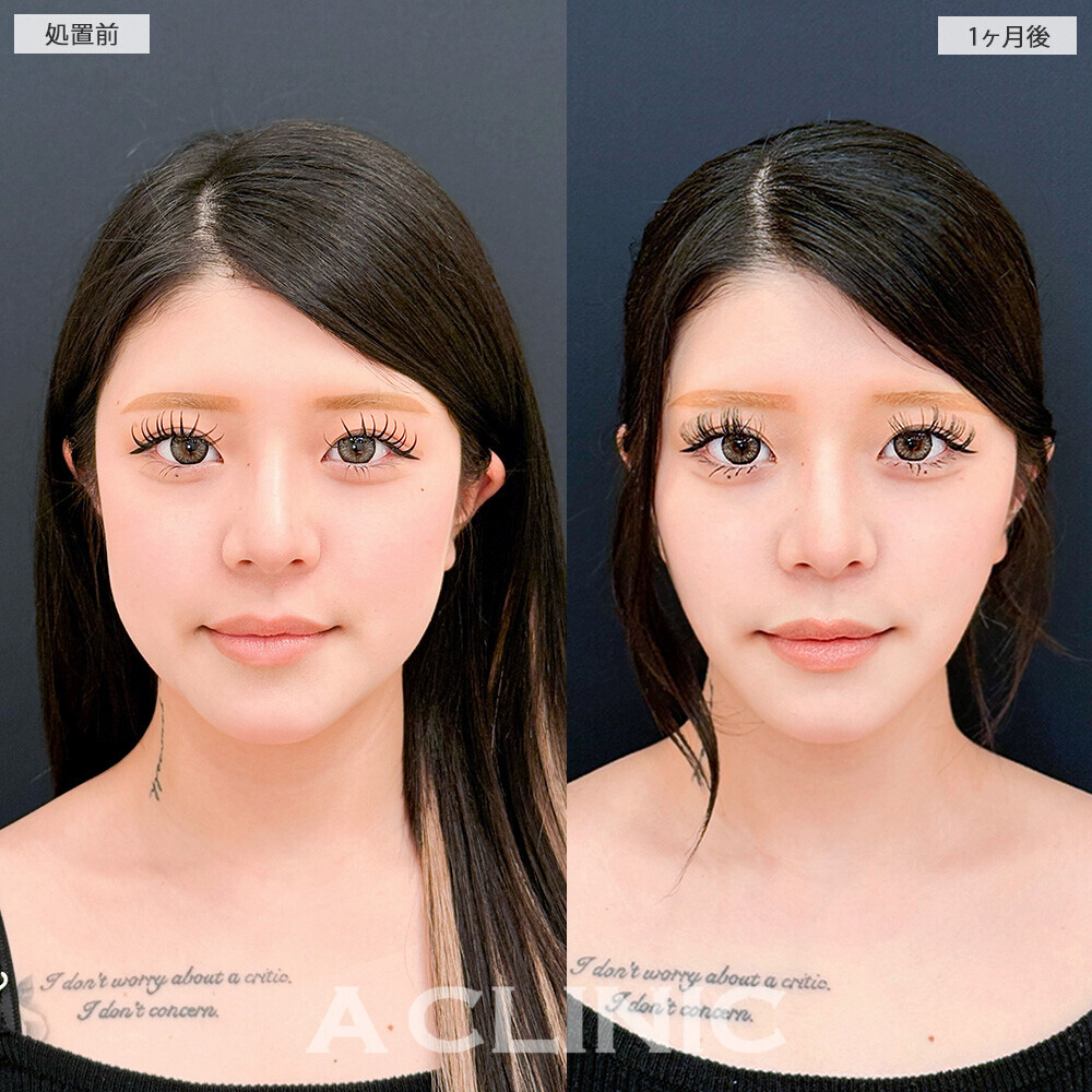 1day小顔脂肪吸引と小顔エラボトックスで輪郭が変わるだけで垢抜け成功！こちら処置前から2ヶ月後の症例です(10代女性)