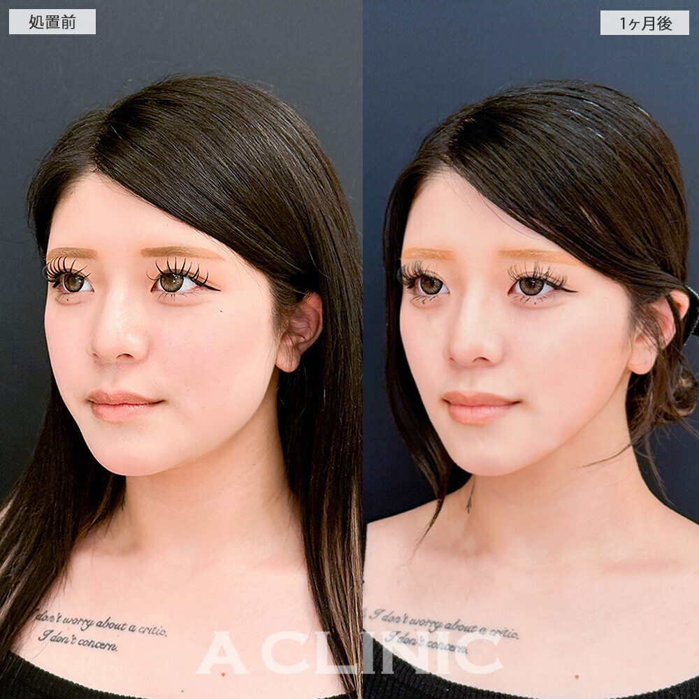 1day小顔脂肪吸引と小顔エラボトックスで輪郭が変わるだけで垢抜け成功！こちら処置前から2ヶ月後の症例です(10代女性)