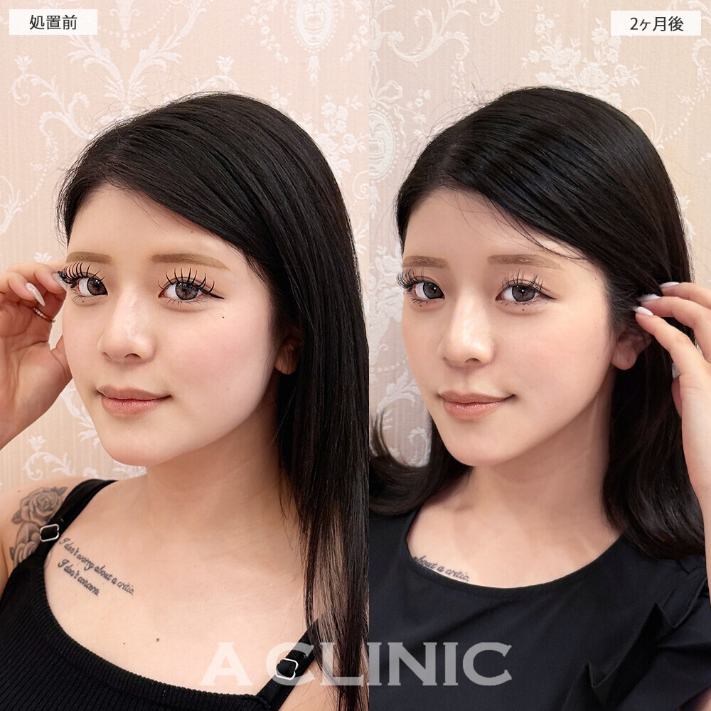 1day小顔脂肪吸引と小顔エラボトックスで輪郭が変わるだけで垢抜け成功！こちら処置前から2ヶ月後の症例です(10代女性)