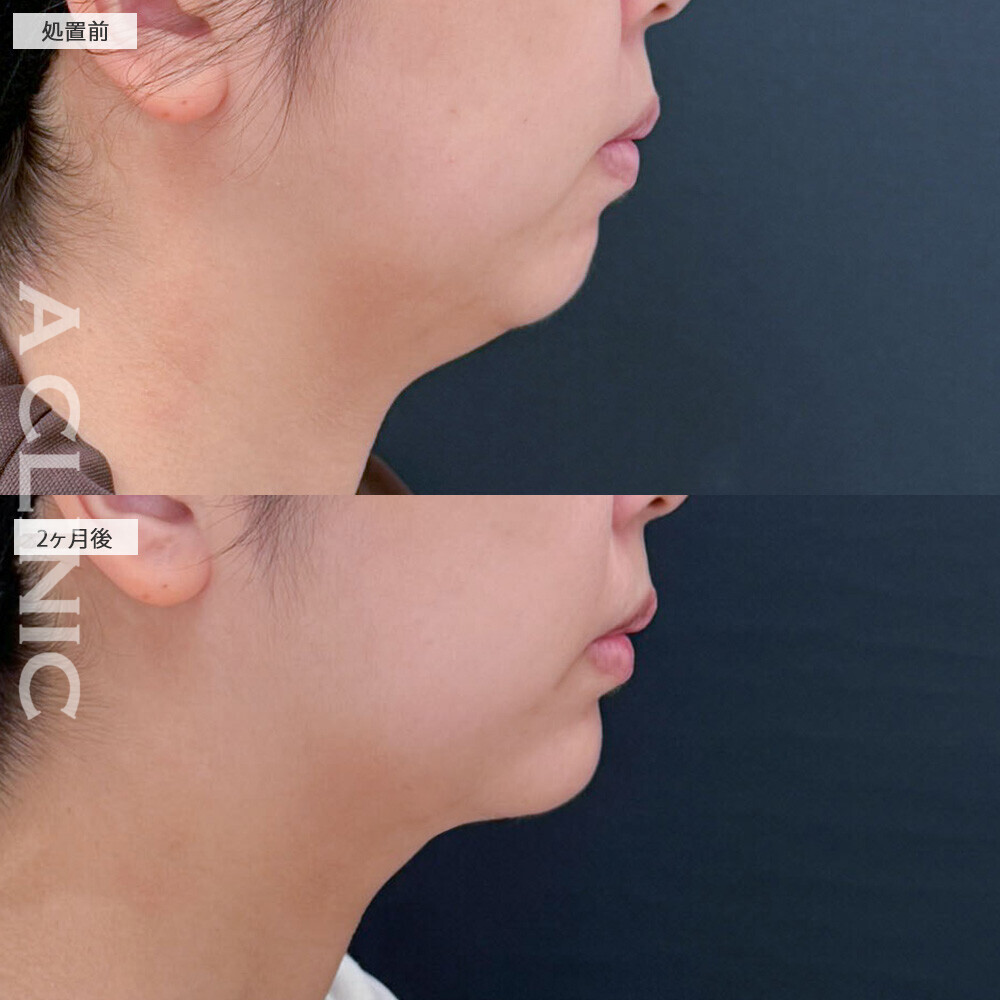 1day小顔脂肪吸引と小顔エラボトックスで二重あごが気にならなくなりました！こちら処置前から2ヶ月後の症例です(30代女性)