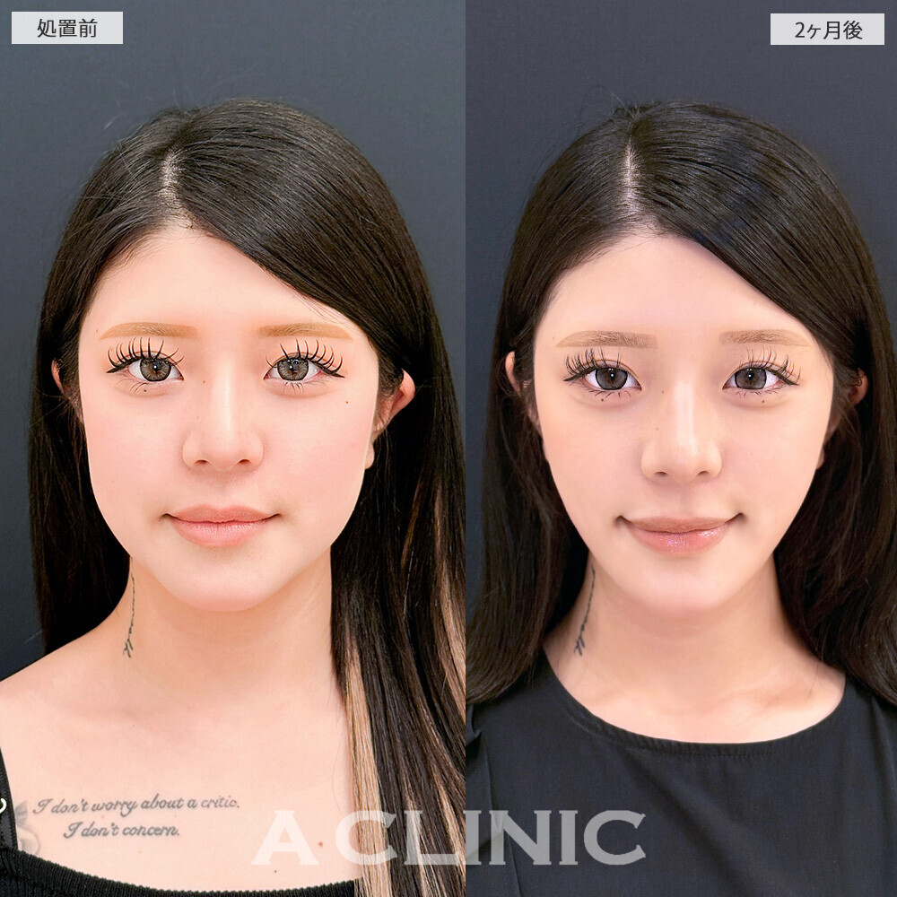 1day小顔脂肪吸引と小顔エラボトックスで輪郭が変わるだけで垢抜け成功！こちら処置前から2ヶ月後の症例です(10代女性)
