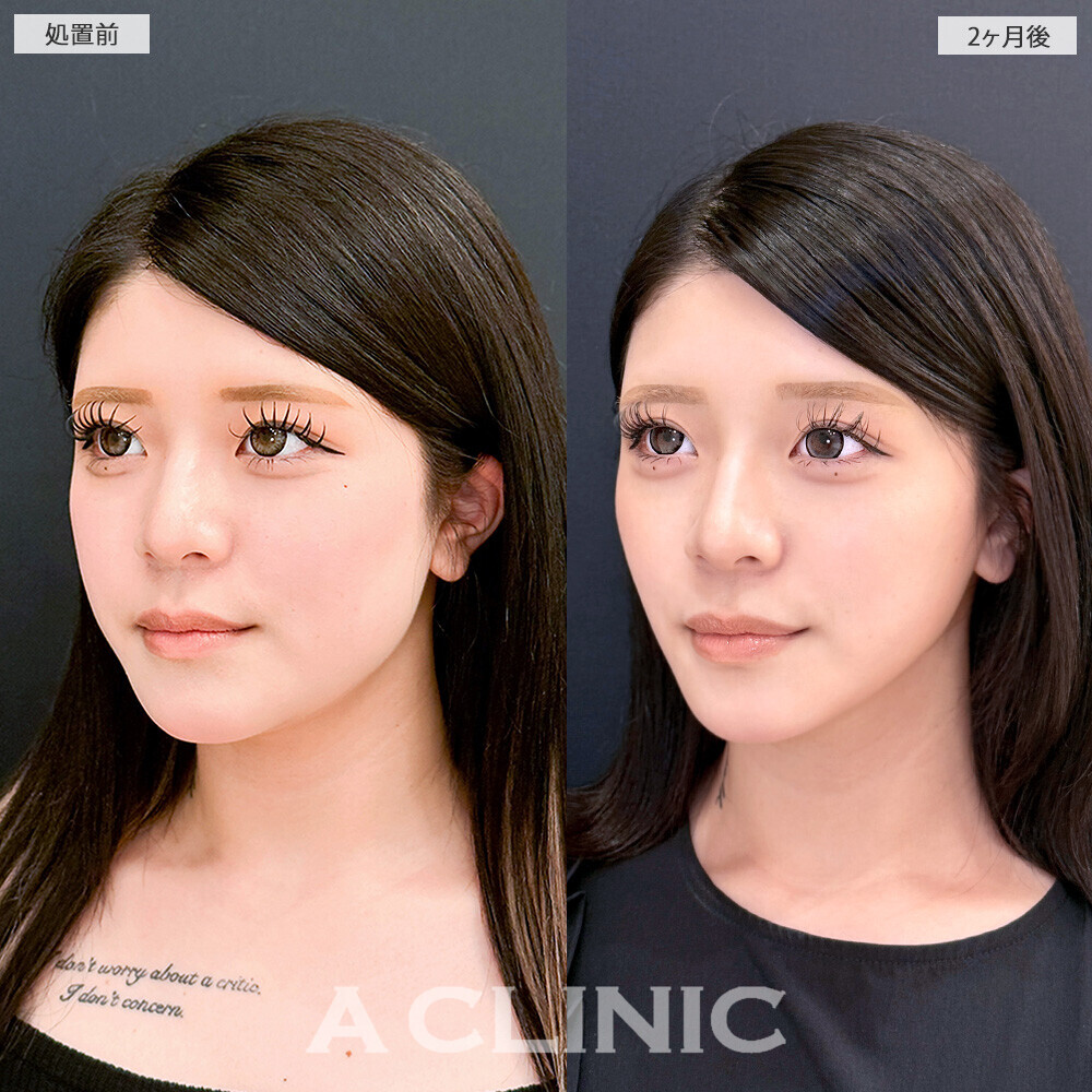 1day小顔脂肪吸引と小顔エラボトックスで輪郭が変わるだけで垢抜け成功！こちら処置前から2ヶ月後の症例です(10代女性)
