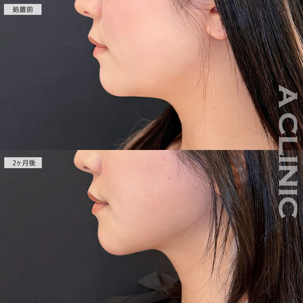 1day小顔脂肪吸引と小顔エラボトックスで輪郭が変わるだけで垢抜け成功！こちら処置前から2ヶ月後の症例です(10代女性)