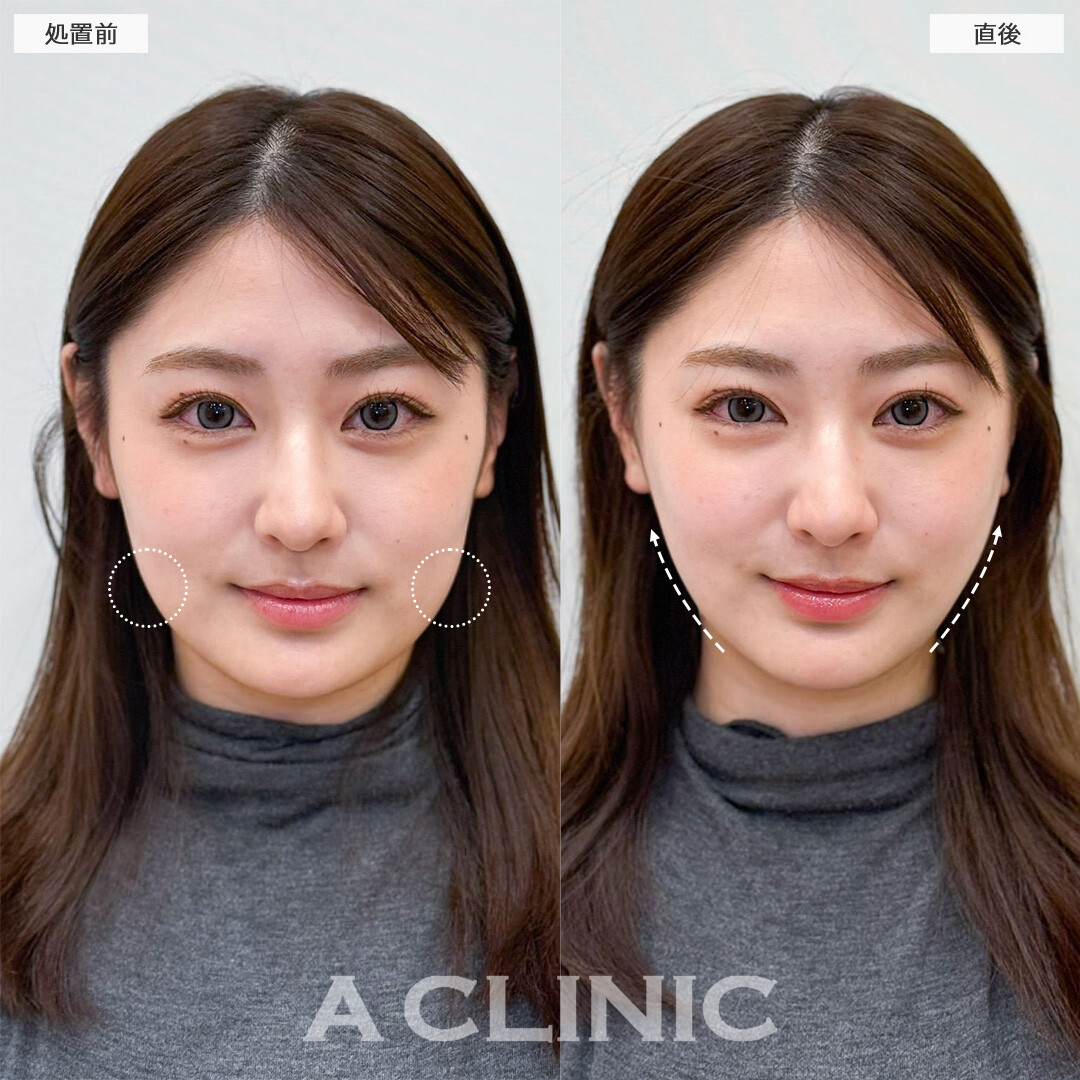 1day小顔脂肪吸引なら直後から固定バンド不要で小顔を実感！こちら処置前と処置後の症例です(20代女性)