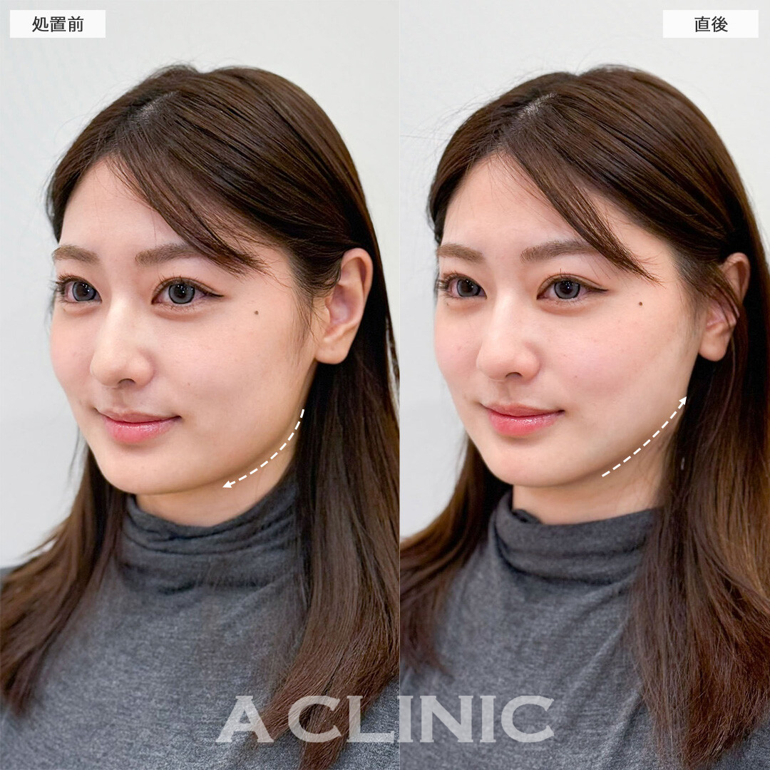 1day小顔脂肪吸引なら直後から固定バンド不要で小顔を実感！こちら処置前と処置後の症例です(20代女性)