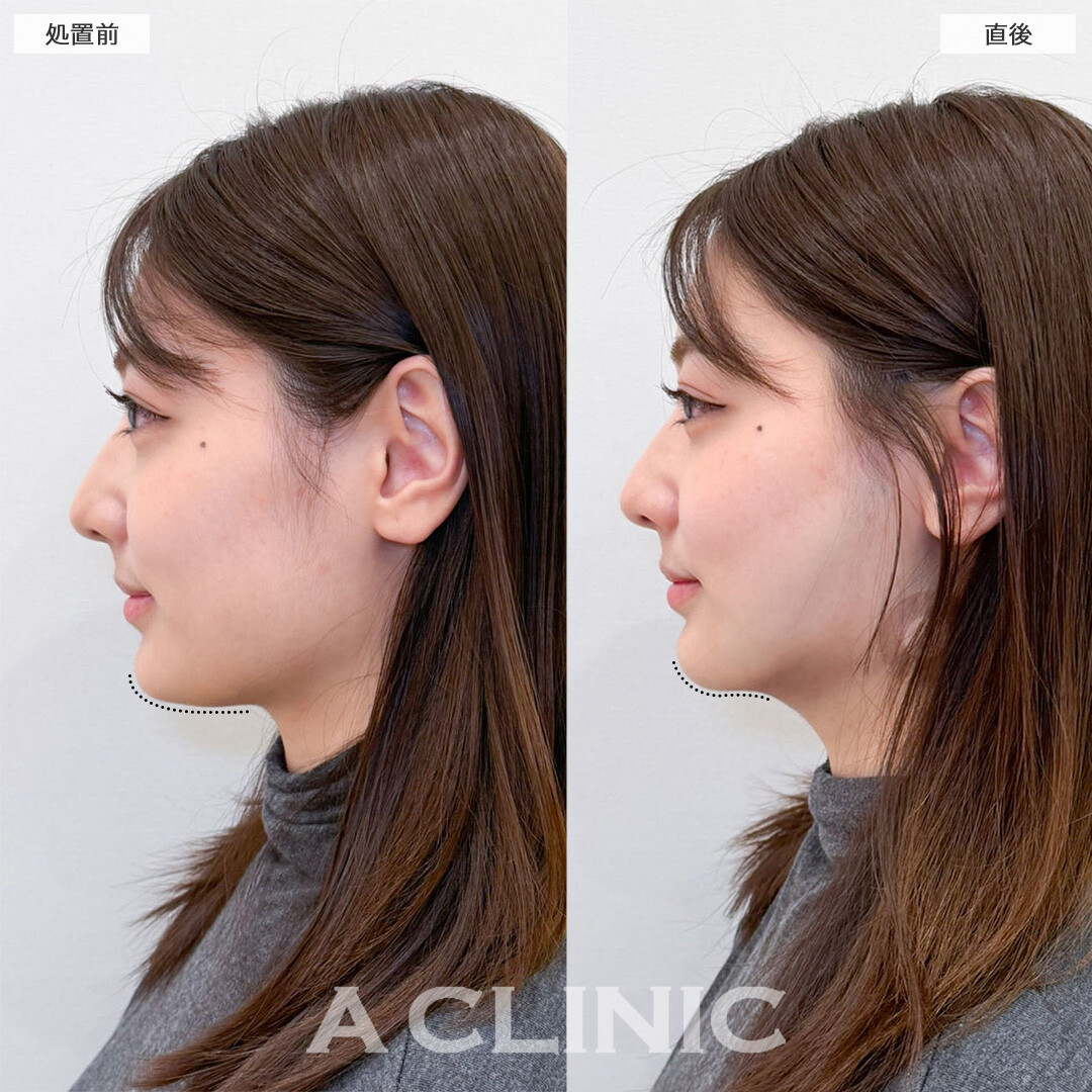 1day小顔脂肪吸引なら直後から固定バンド不要で小顔を実感！こちら処置前と処置後の症例です(20代女性)