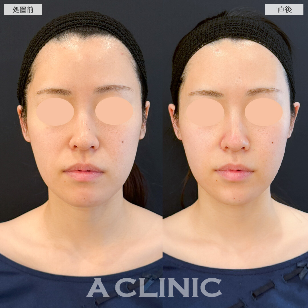 XERF(ザーフ)でキュッと引き締めたるみの目立たないお肌へ！処置前と直後の症例です(20代女性)