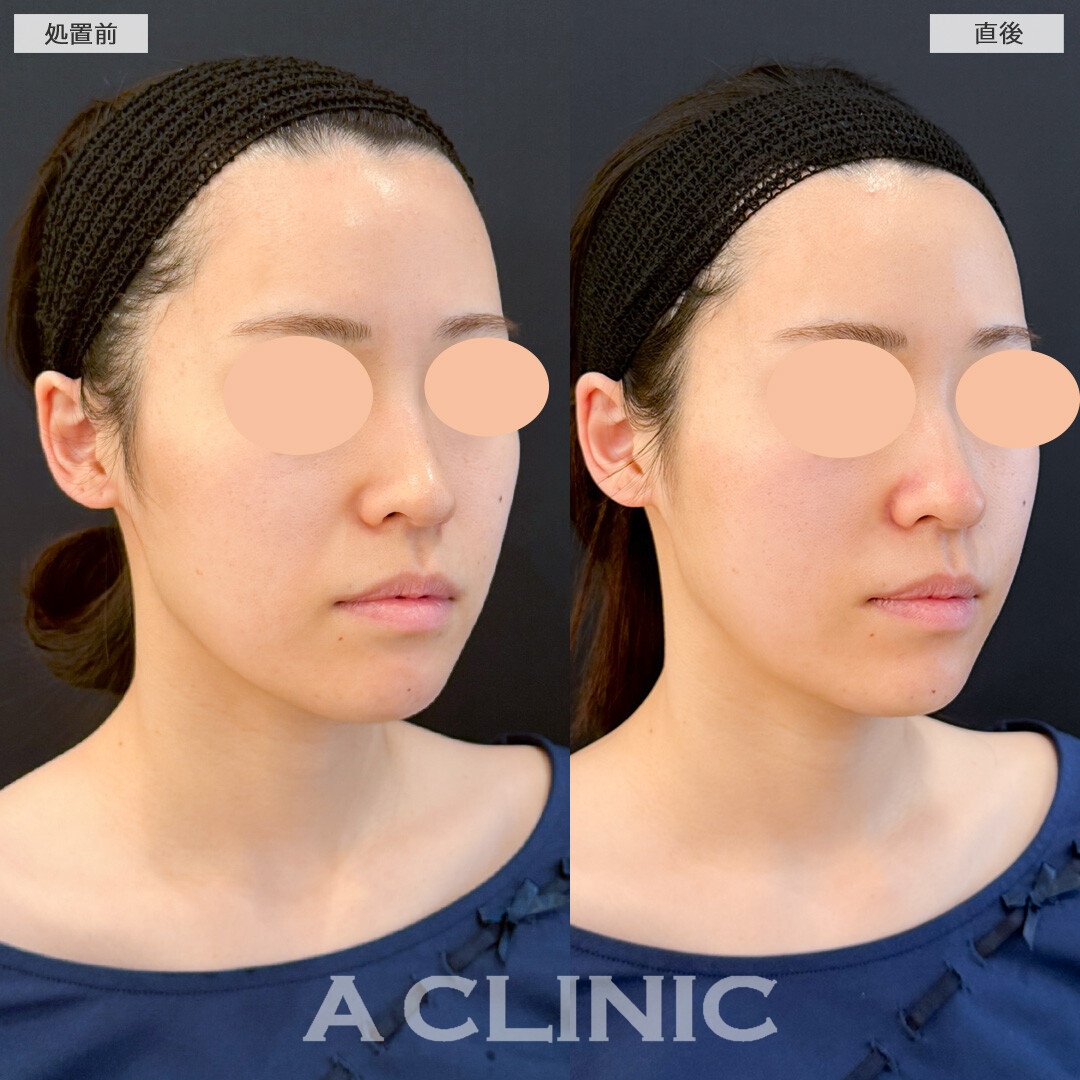 XERF(ザーフ)でキュッと引き締めたるみの目立たないお肌へ！処置前と直後の症例です(20代女性)