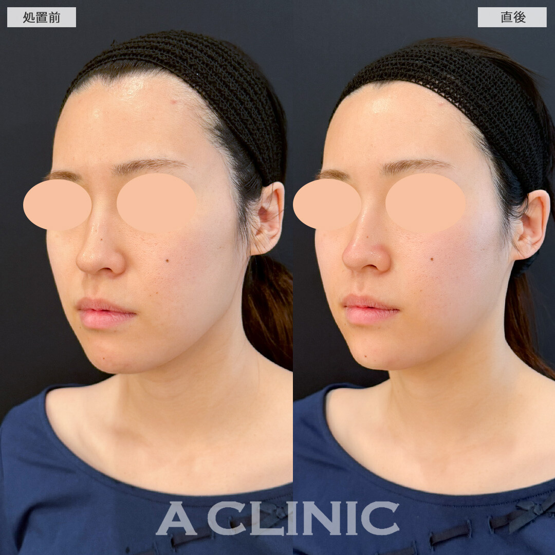XERF(ザーフ)でキュッと引き締めたるみの目立たないお肌へ！処置前と直後の症例です(20代女性)