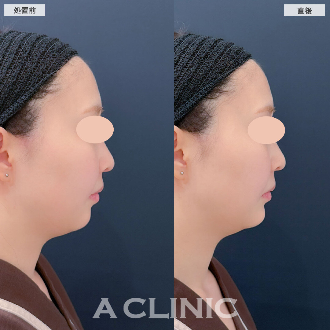 あごへのヒアルロン酸注入でEラインを整えます！こちら処置前と直後の症例です(20代女性)