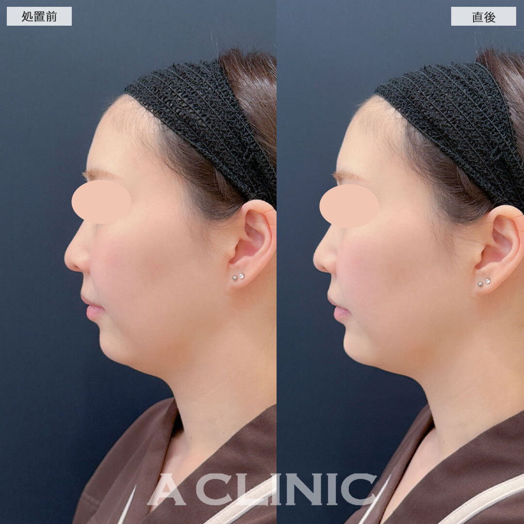 あごへのヒアルロン酸注入でEラインを整えます！こちら処置前と直後の症例です(20代女性)