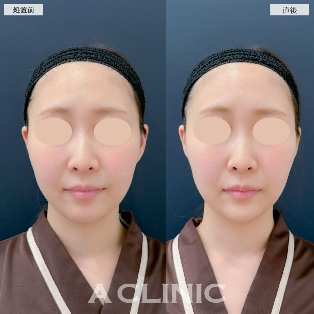 あごへのヒアルロン酸注入でEラインを整えます！こちら処置前と直後の症例です(20代女性)